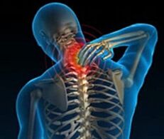 Osteocondrose da columna cervical