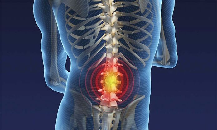 Dor na rexión lumbar