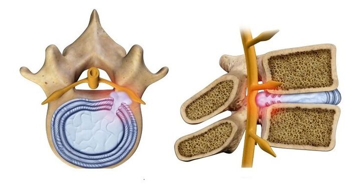 Hernia discal abombamento do núcleo do disco na canle espiñal